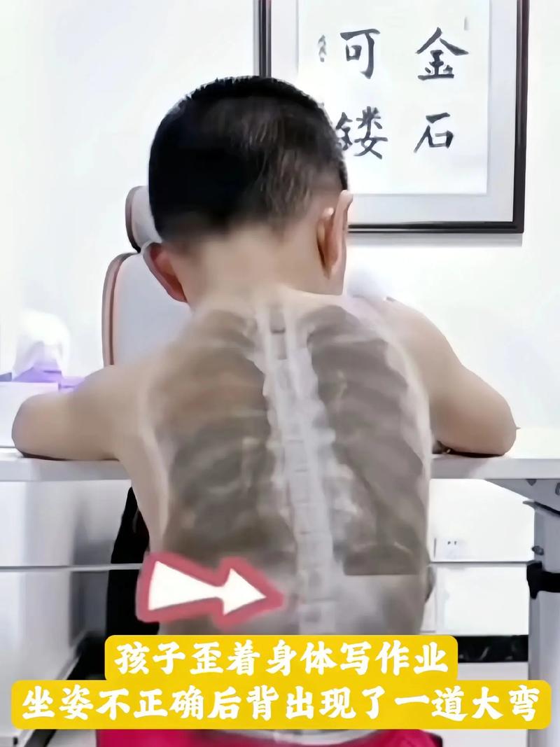 孩子坐姿不正，警惕脊柱侧弯风险
