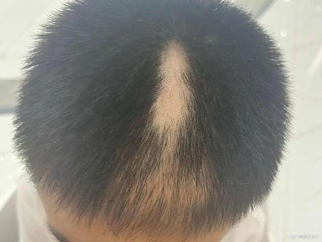 少女吃头发成瘾，胃里惊现四斤发石——揭秘背后的故事