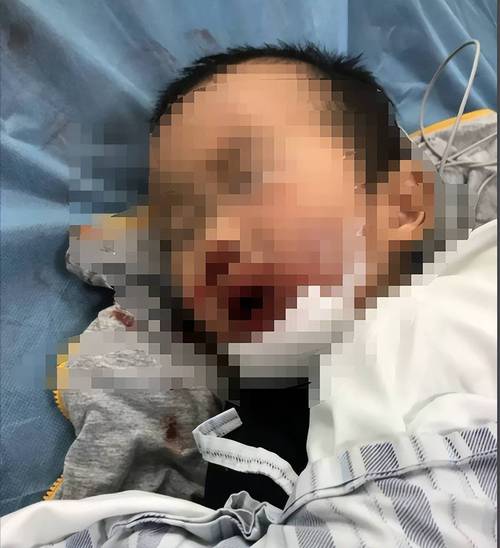 3岁女童意外头部插刀事件，妈妈不慎造成惊险一幕