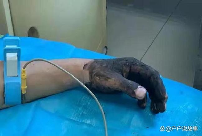 大叔遭两种蛇咬伤引发血清过敏危机