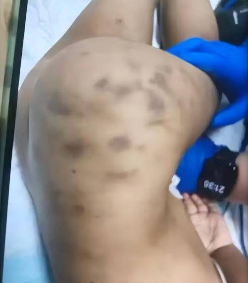 广西女子锤击儿童事件，精神障碍患者行凶引发关注