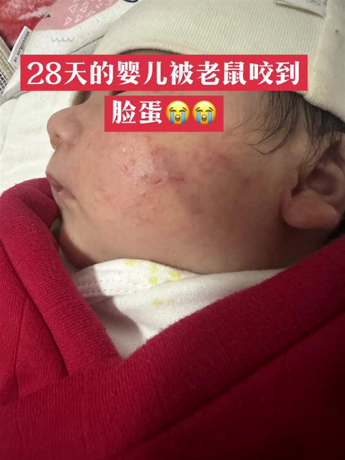 印度某医院新生儿遭老鼠咬伤事件曝光