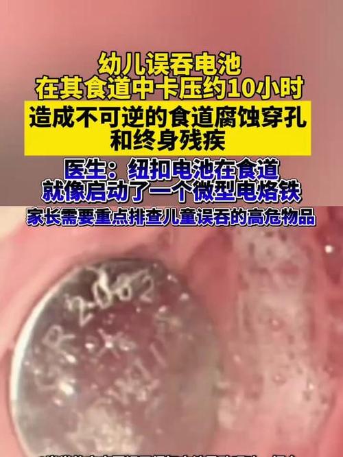 幼儿误吞电池引发终身残疾悲剧警示家长注意孩子安全