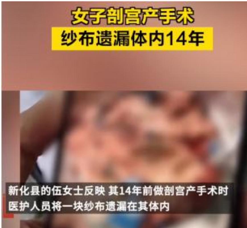 女子术后惊现体内纱布滞留20天，恶臭难当！