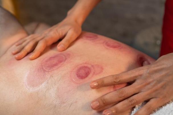 男子连续两天在家拔火罐引发高位截瘫的悲剧提醒，安全拔罐，避免风险！